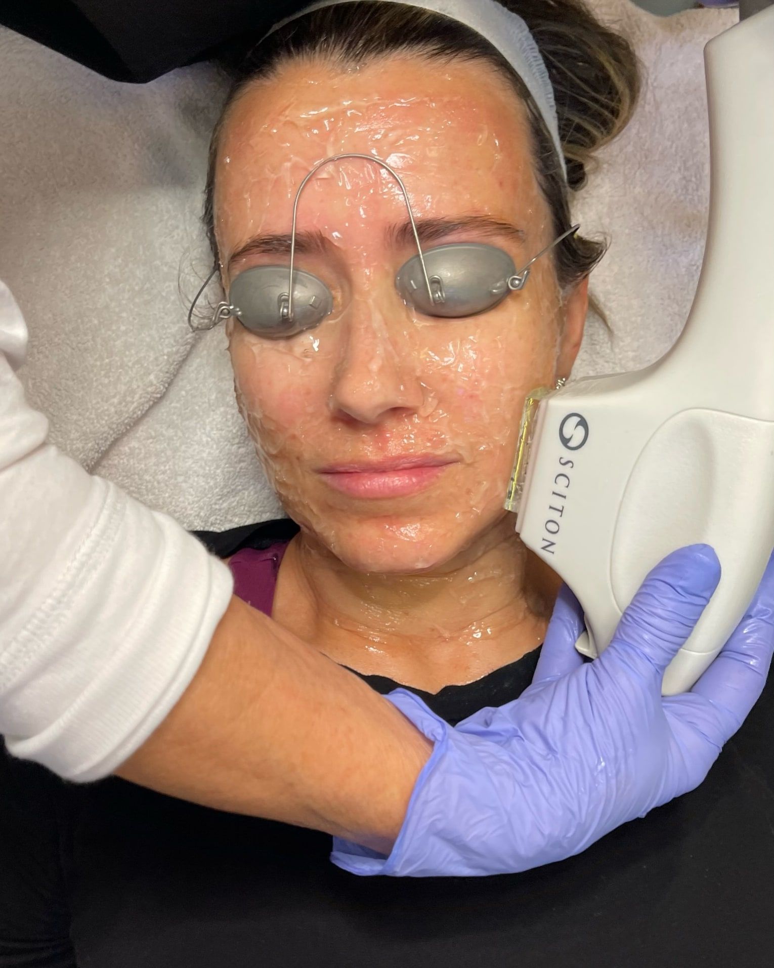 IPL Photofacial at Wellspring Skincare in Roswell