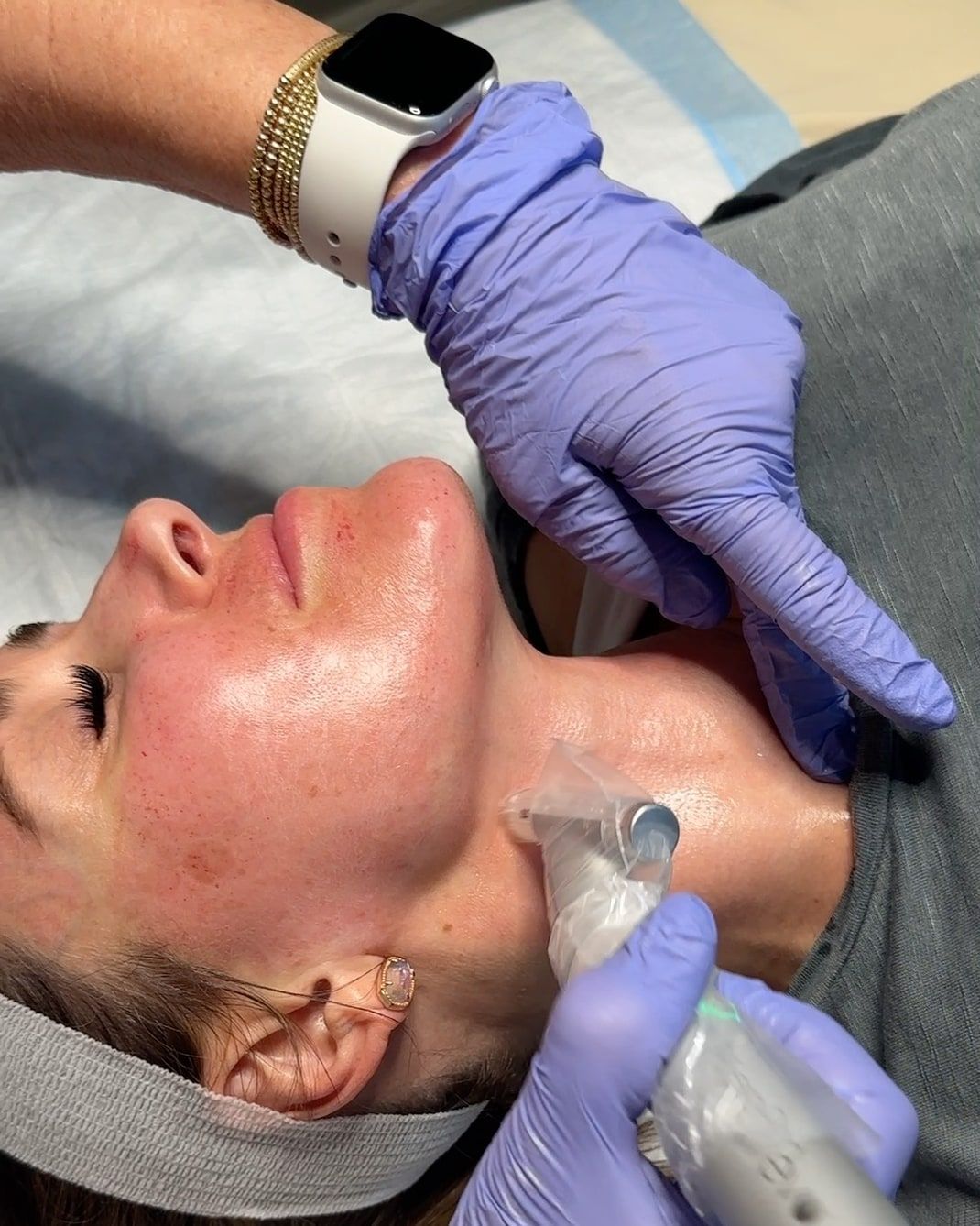 Microneedling at Wellspring Skincare in Roswell